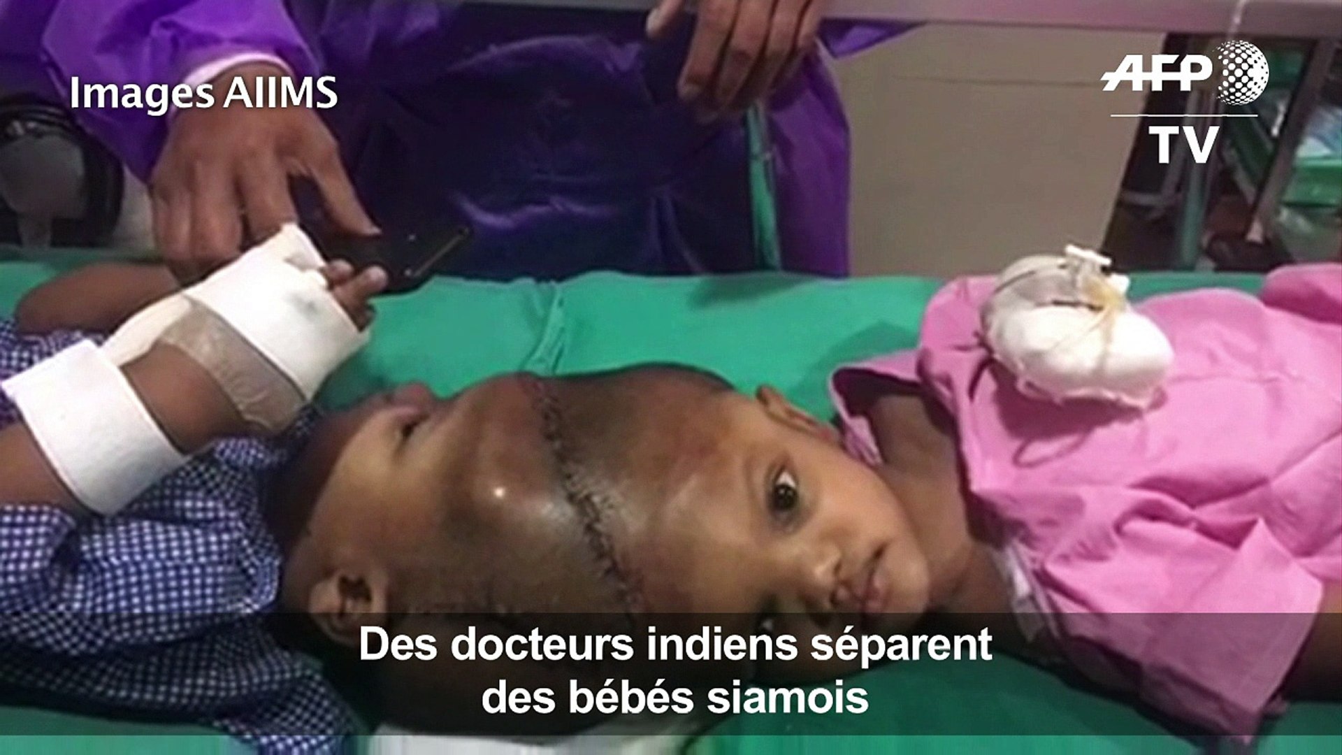 Des Docteurs Indiens Séparent Des Bébés Siamois
