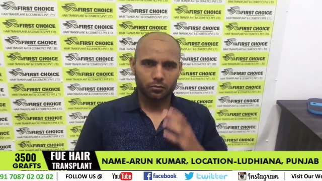 Hair Transplant Procedure @FCHTC Clinic Ludhiana - 3500 Grafts