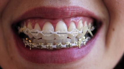 to choose clear brackets and bands or not?