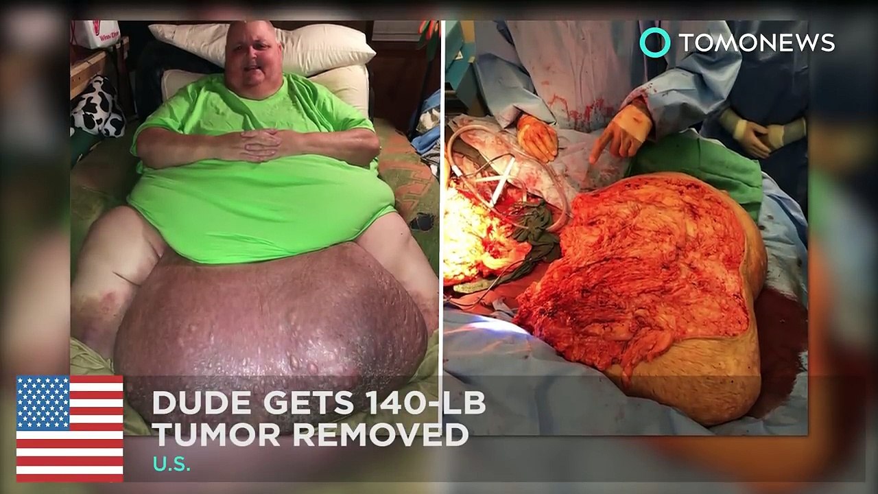 Tumors: Ingrown hair turns into 140-pound tumor in mans stomach; Eyeball cancer - Compilation