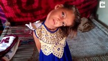 La tête coincée à 90 degrés à cause d'une maladie en Inde cette fillette vit recluse du monde