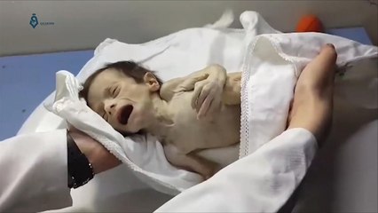 نقص التغذية الحاد يهدد حياة 1500 طفل بالغوطة الشرقية