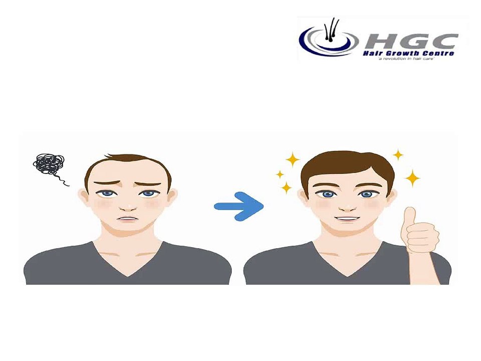10_Must_Knows_tips_Before_Getting_Hair_Transplants