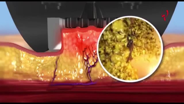 7 نصائح للوقاية من خطر الموت بسبب جراحة شفط الدهون