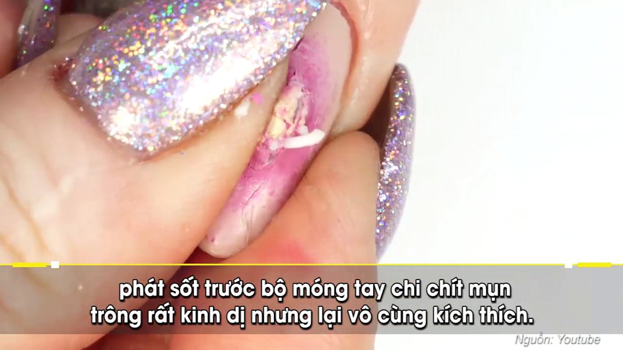 Nặn mụn trên móng tay, mốt làm đẹp khiến các “tín đồ nặn mụn” phát sốt