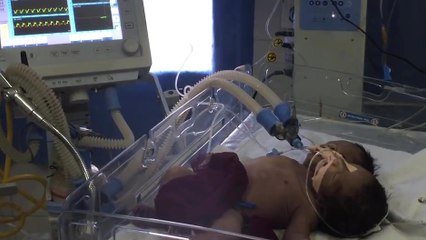 Un bébé né avec deux têtes