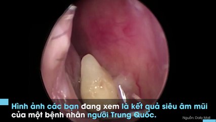 Chuyện lạ đời: Răng mọc ngược xuyên lên lỗ mũi