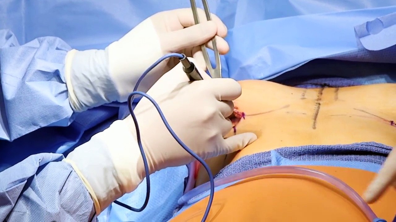 Shaped, Anatomic, Gummy Bear, Tear Drop Cohesive Gel Breast Augmentation by Seattle's DR. Parikh MD