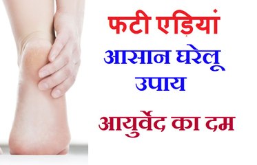 फटी एड़ियों का घरेलू नुस्खा | Fati Ediyon Ka Ilaj | Home Remedies For Cracked Heels