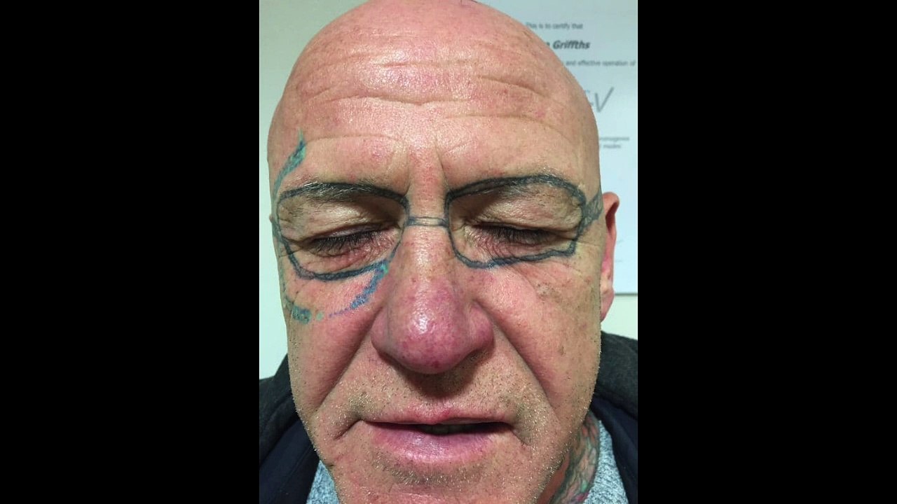 Il a fallu deux ans pour faire disparaître son horrible tatouage sur le visage au laser...
