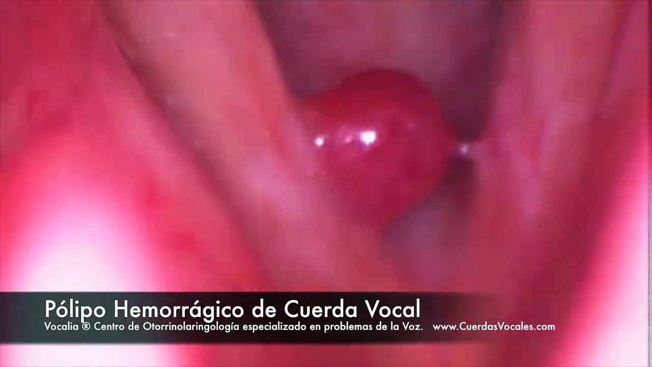 Pólipo Hemorrágico de Cuerdas Vocales - Hemorrhagic vocal fold polyp - Cuerdas Vocales - Vocalia ®