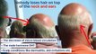 Best Hair loss treatment | How to stop hair loss naturally and baldness cure 2016