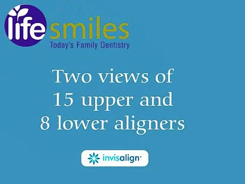Dr Geisler s Invisalign Progression - Life Smiles Family Dentistry