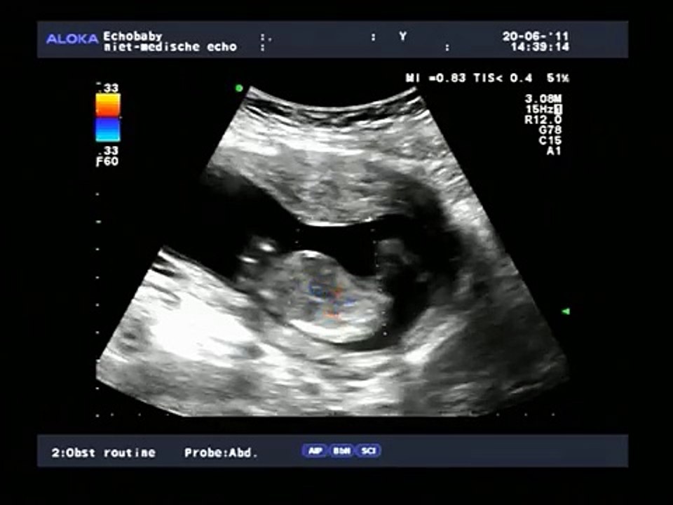 2D en 3D-echo 15 weken meisjes