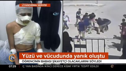 Lise öğrencisi böyle yandı