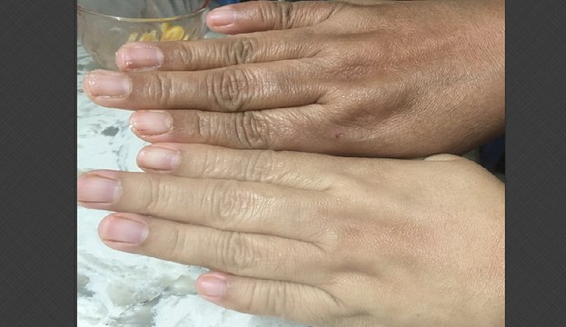 Skin Whitening Natural Bleach 100% Effective/Miracle Formula (Results In LIVE Video)