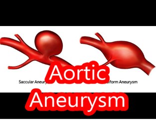 Aortic Aneurysm