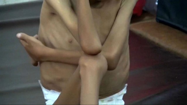 Yemen: milioni di morti per fame, è la peggiore carestia di sempre