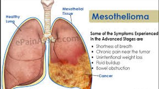 Mesothelioma Cancer - What is Mesothelioma | Types of Mesothelioma Cancer - Mesothelioma Symptoms