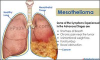 Mesothelioma Cancer - What is Mesothelioma | Types of Mesothelioma Cancer - Mesothelioma Symptoms