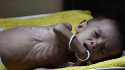 قلق أممي و 15 منظمة تحذر من كارثة باليمن