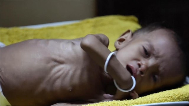 قلق أممي و 15 منظمة تحذر من كارثة باليمن