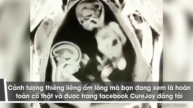 Hai em bé sinh đôi nằm trong bụng mẹ đánh nhau dữ dội để tranh nhau làm anh