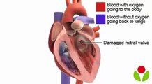 How heart valve replacement surgery is performed