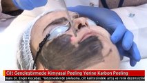 Cilt Gençleştirmede Kimyasal Peeling Yerine Karbon Peeling