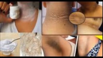 Cómo eliminar las manchas negras del cuello, codos y axilas