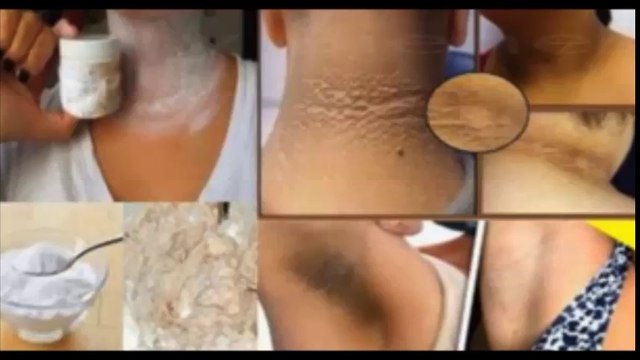 Cómo eliminar las manchas negras del cuello, codos y axilas
