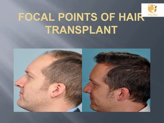 Focal points of Hair transplant