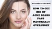Get Rid of Acne Scars Fast - How to Get Rid Of Acne Scars Fast Naturally Overnight
