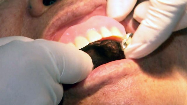 틀니, 전용 세정제 사용하고 정기 검진 받아야 / YTN