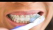 Effective And Quick Ways To Whiten Your Teeth Naturally 2017 HD