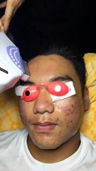 Trị mụn viêm ở tại trung tâm spa thủ đức, Hotline tư vấn :0981 829 916