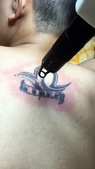 Xoá hình xăm ở tại thủ đức, Hotline tư vấn :0981 829 916