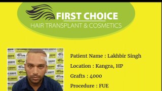Lakhbir's Hair Transplant Procedure @FCHTC Clinic Ludhiana - 4000 hair grafts