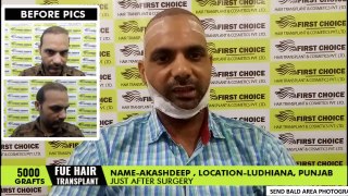 Patient Testimony - 5000 hair grafts transplanted with Fue technique - FCHTC Ludhiana