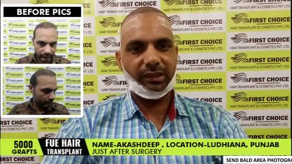 Patient Testimony - 5000 hair grafts transplanted with Fue technique - FCHTC Ludhiana