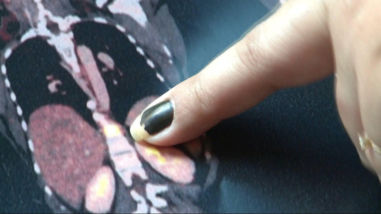 Cancer patients face ‘delays’ in cash-strapped Rio hospitals