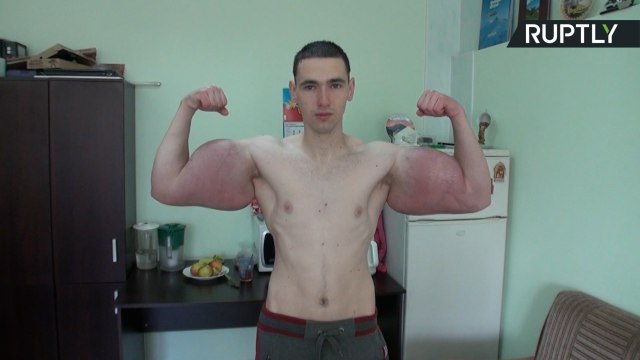 No Pain, No Gain? 21yo Grows Enormous Biceps After Drug Injections
