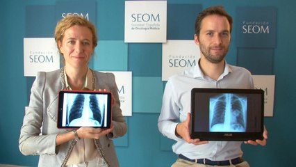 La SEOM informa: "Fumar te asegura un cáncer de pulmón"