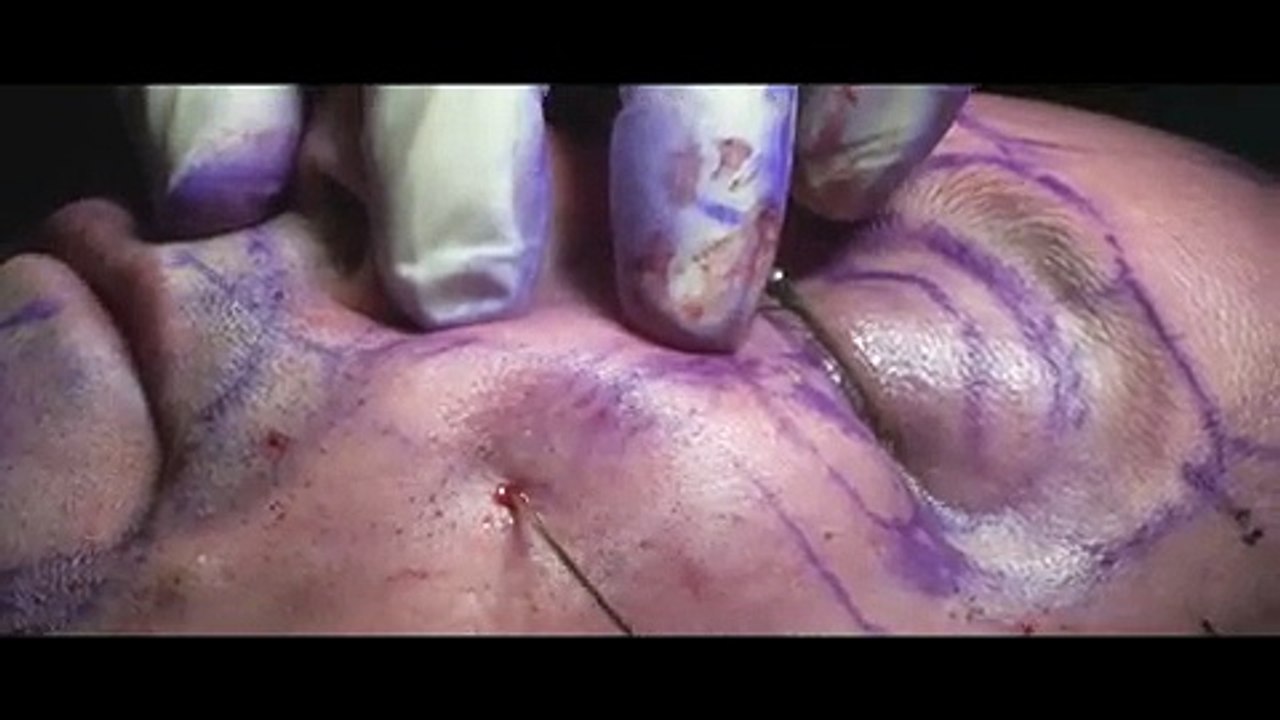 Live Surgery Cheek Fat Grafting, Midface - Cheek Lift, Cheek Implants, Seattle Bellevue's Dr. Young