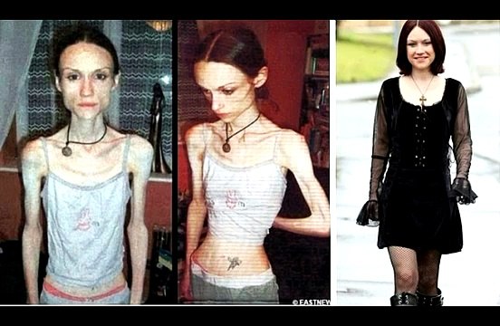 ANOREKSİYA NERVOZAYA SAVAŞ AÇAN VE KAZANAN İNSANLAR