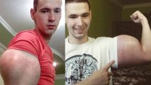 Russian Lunatic Injects Himself with OIL to Get Bigger Muscles