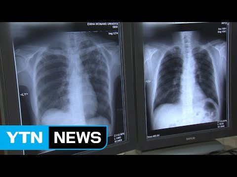 [단독] 광주시 어린이집 원아 20명 집단 잠복 결핵 / YTN (Yes! Top News)