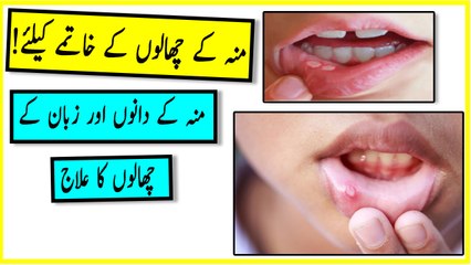 Munh ke dano aur chalon ke liye - Mun ke dano aur zuban ke chalo ka ilaj   منہ کے چھالوں کا علاج