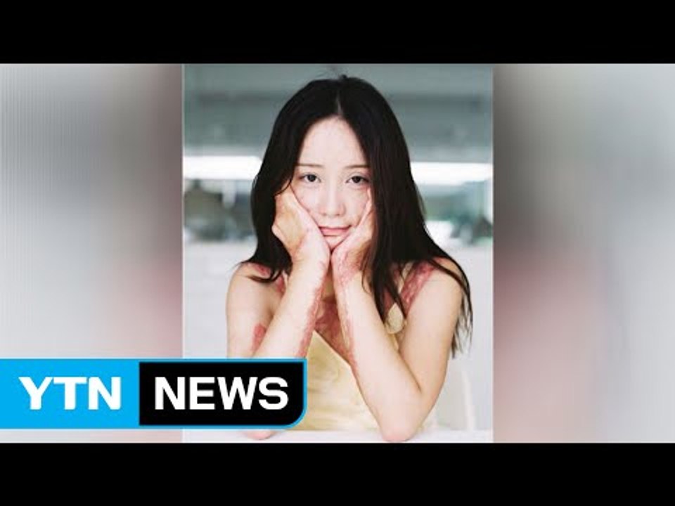 화상 테러 5년 후..."더 이상 숨어있지 않겠다" / YTN (Yes! Top News)