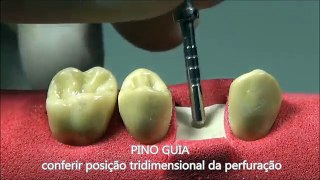 IMPLANTE DENTÁRIO - passo a passo